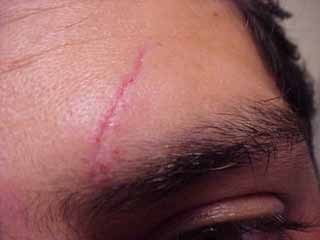 7 Days w/o Stitches